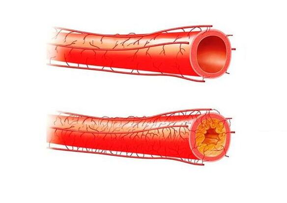 problemas con posibles consecuencias de los vasos sanguíneos
